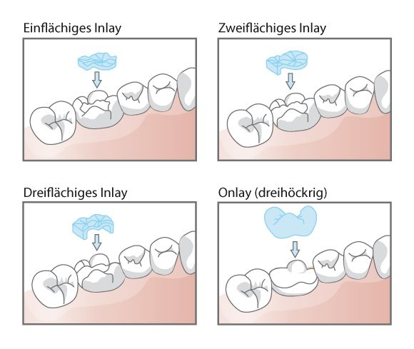 Illustration einer Krone als festsitzender Zahnersatz